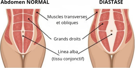 La diastase agit sur le tissu conjonctif et l’étire, séparant alors les muscles des grands droits. Différence d’un torse avec et sans diastase.